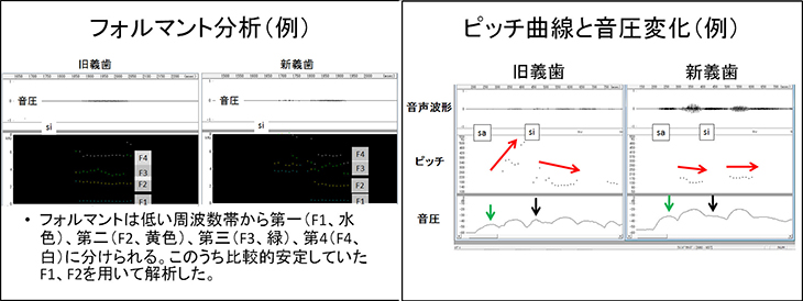 義歯の舌房の拡大が発音に与える影響